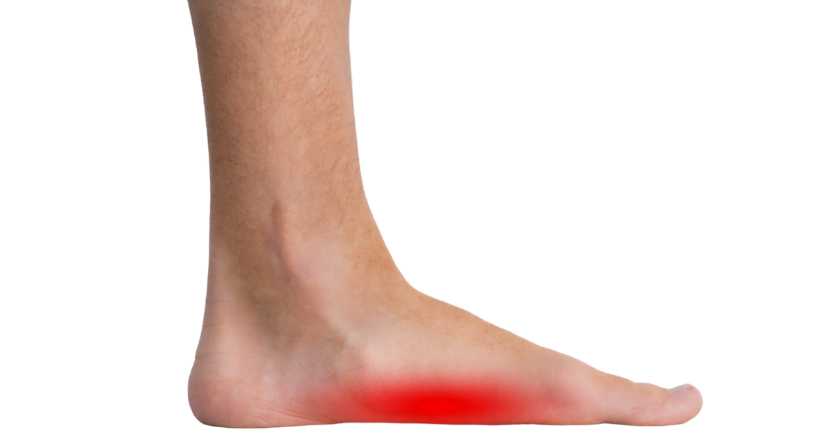 Pie caído | prevenir pie plano