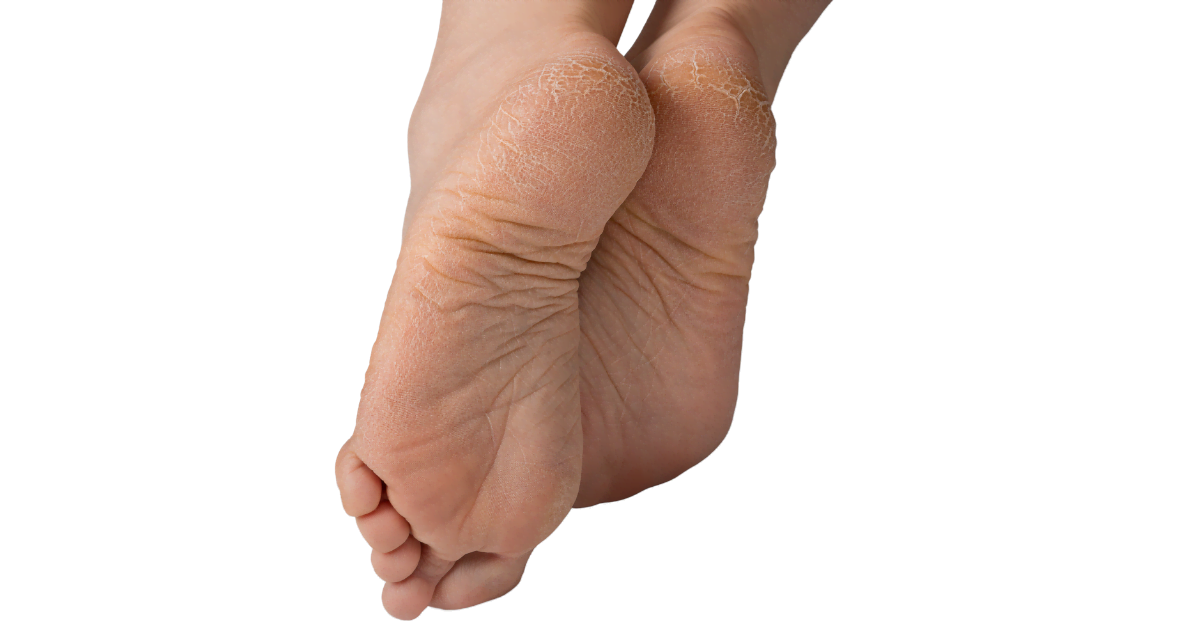 Prevenir y tratar las grietas en el talón