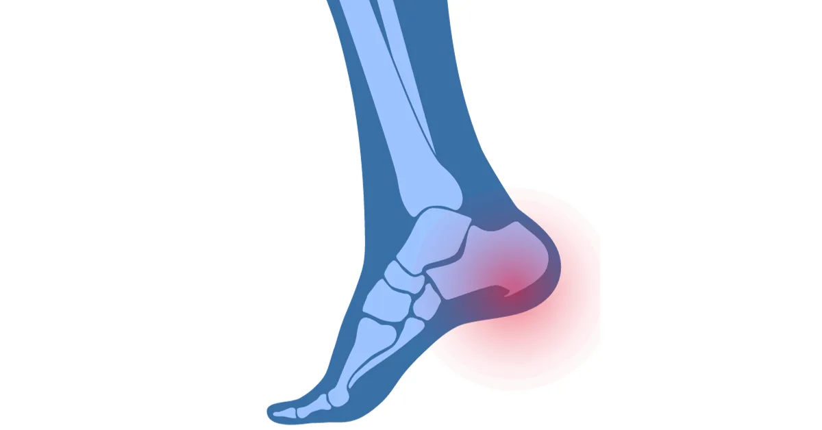 Espolón calcáneo - Aliviar el dolor en el talón