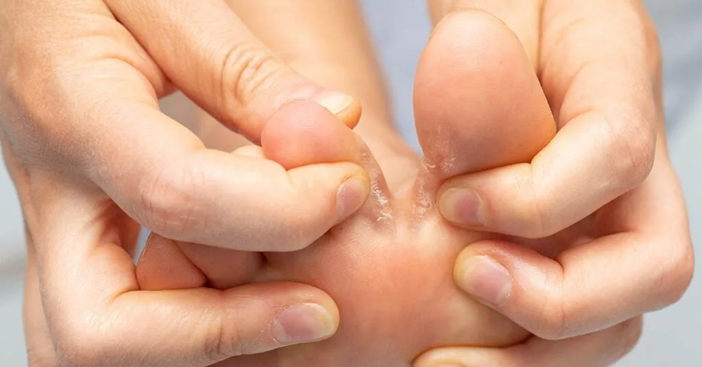 Piel blanca y húmeda entre los dedos de los pies: maceración en la que proliferan las bacterias y el olor.